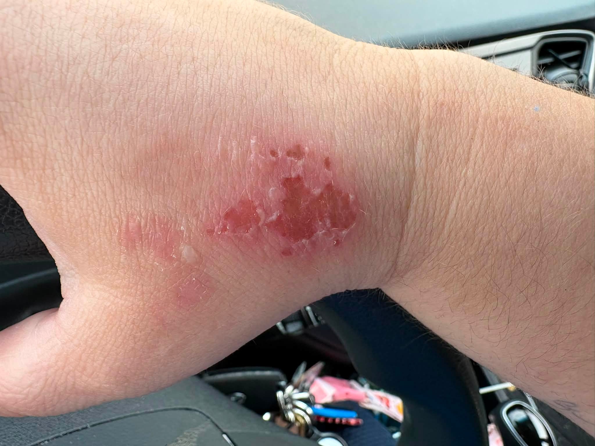 Anyone else here on tirzepatide? Ever since I have been taking it and losing weight along with going to the gym 5 days a week, my hands have been completely clear despite