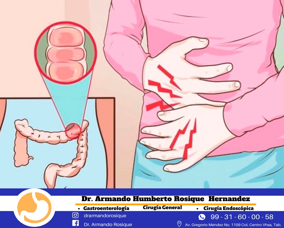 Causas y síntomas de la colitis La mayoría de las veces, la causa de la ...