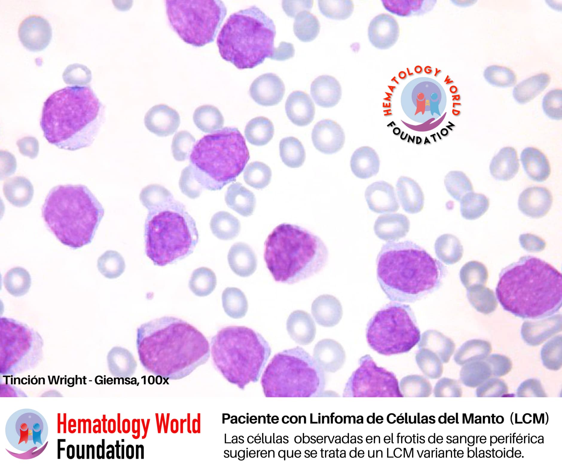 CASO DE LINFOMA DE CÉLULAS... - Hematology World Foundation | Facebook