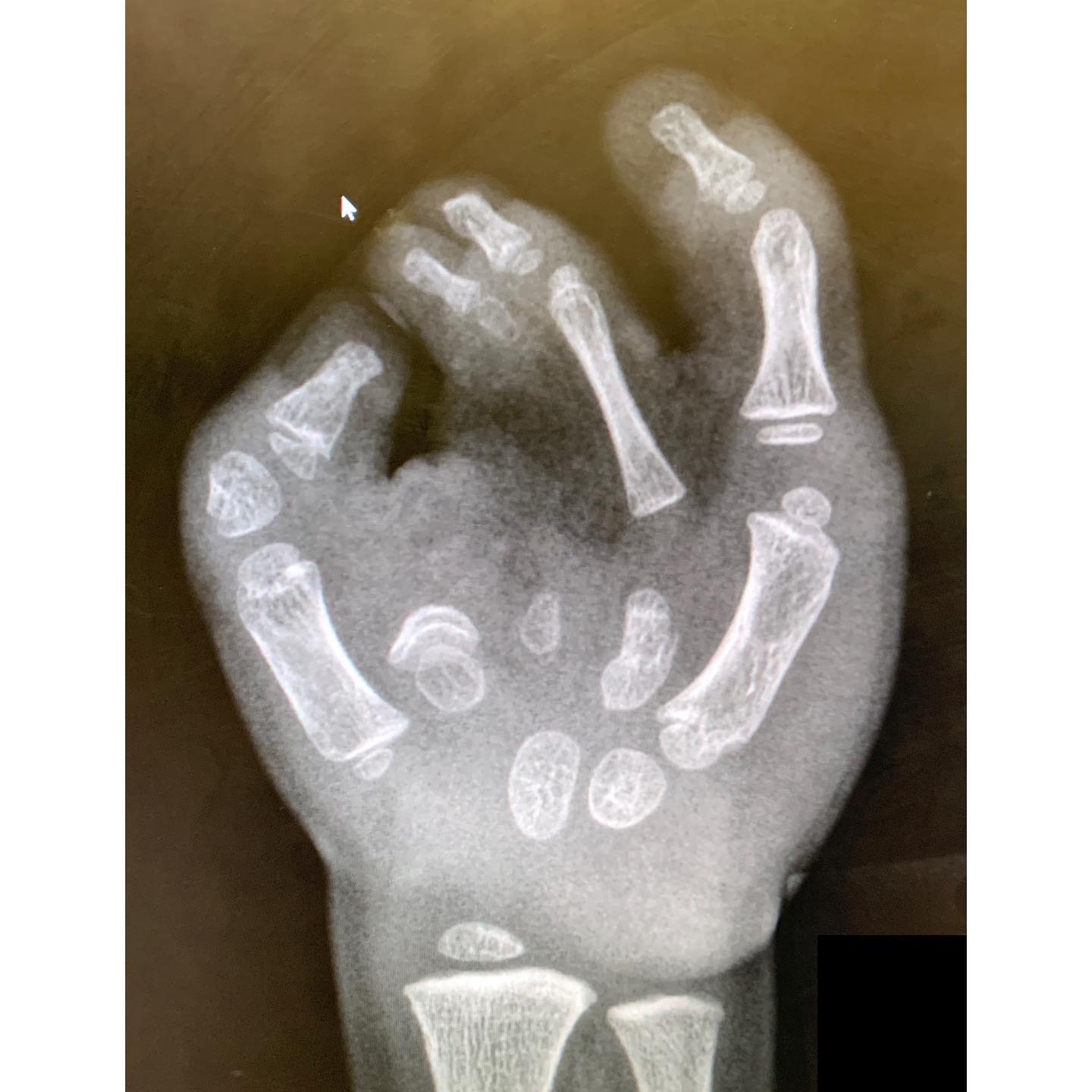 Congenital Hand and Arm Differences