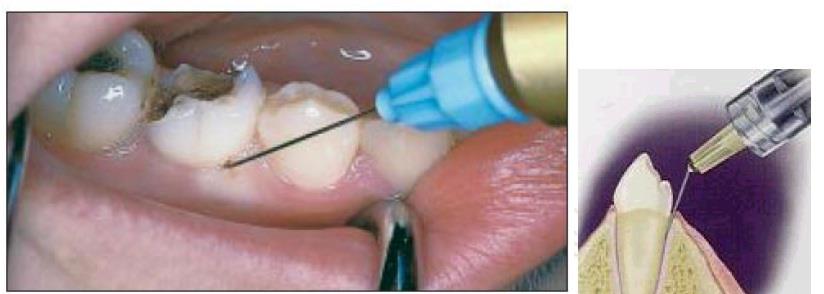 Thaiendodontics - Periodontal ligament (PDL) technique ...