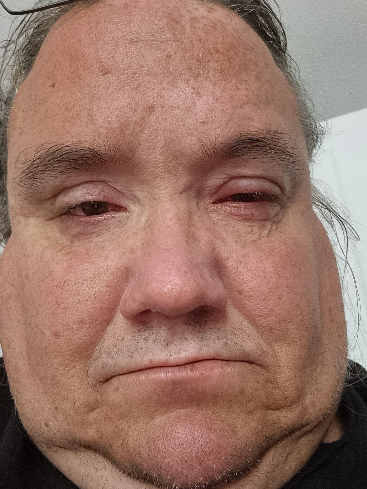 Eye pain upon waking in the morning?