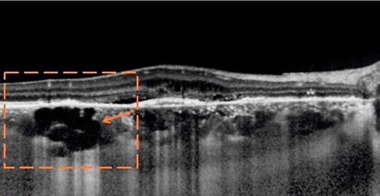 Choroidal Rift in... - Ophthalmology-Notes And Synopses