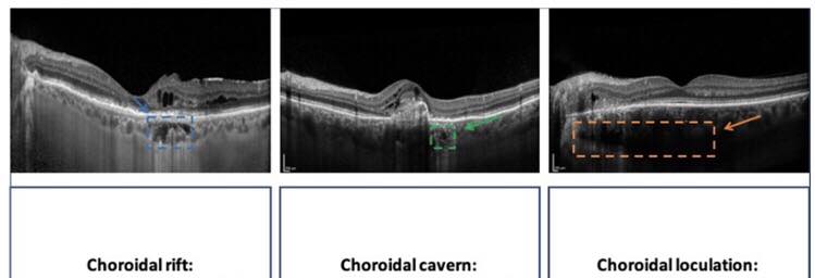 Choroidal Rift in... - Ophthalmology-Notes And Synopses