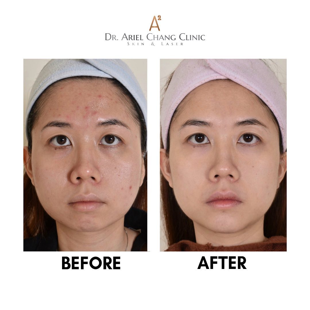 Dr Ariel Chang Clinic Real Patient S Testimonial After Ace Skin Rejuvenation Treatment Looking For A Brighter And Healthier Skin Pm Us Now For More Details Whatsapp At 0183893321 Written Consent