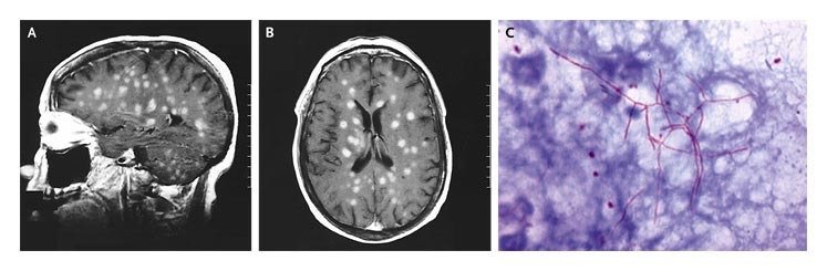 จับฉ่าย - Ring enhancing lesion ใน brain เรามาดูกันครับ ก่อนจะไปที่ ...