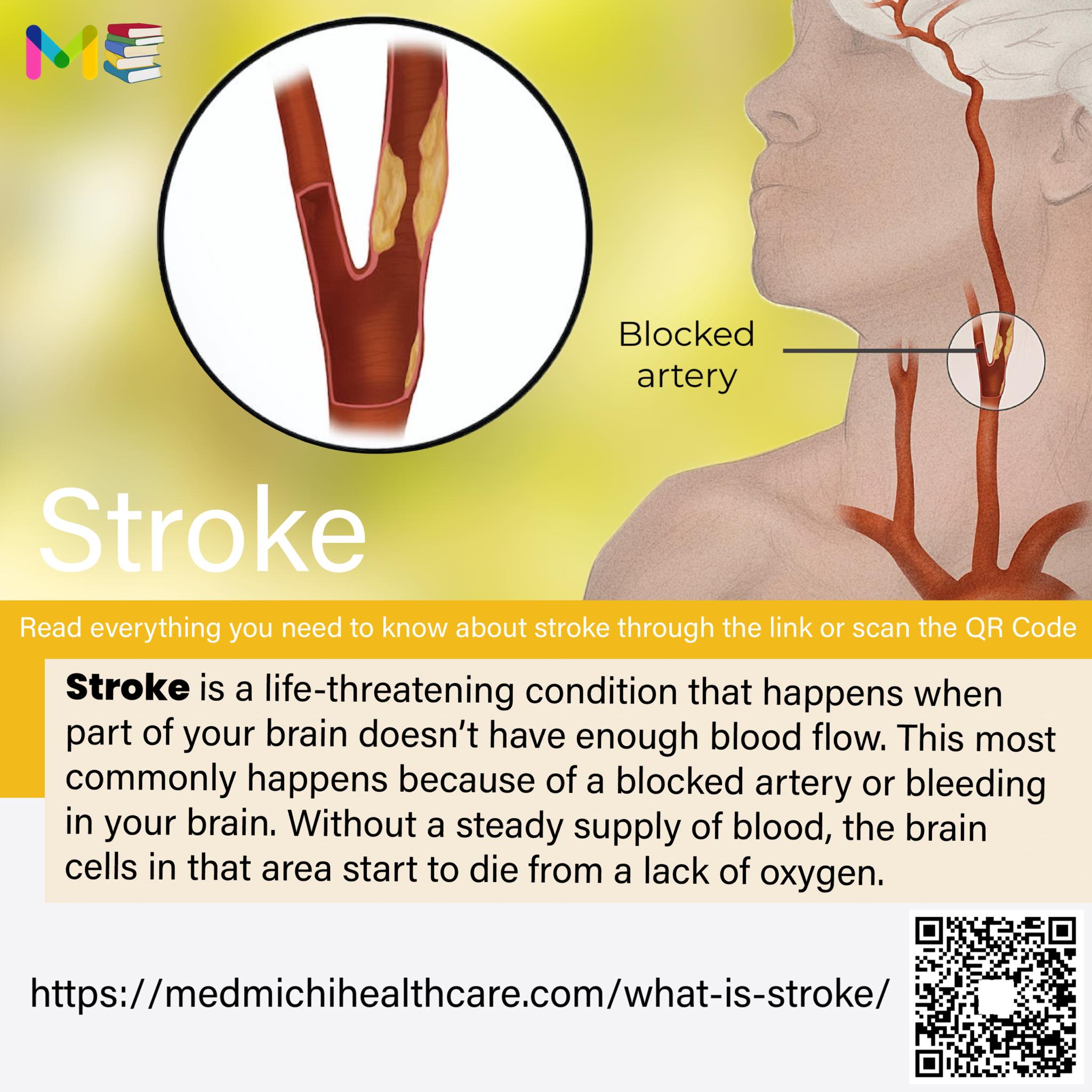 📚Full note on STROKE [with pdf]👉... - Medmichihealthcare