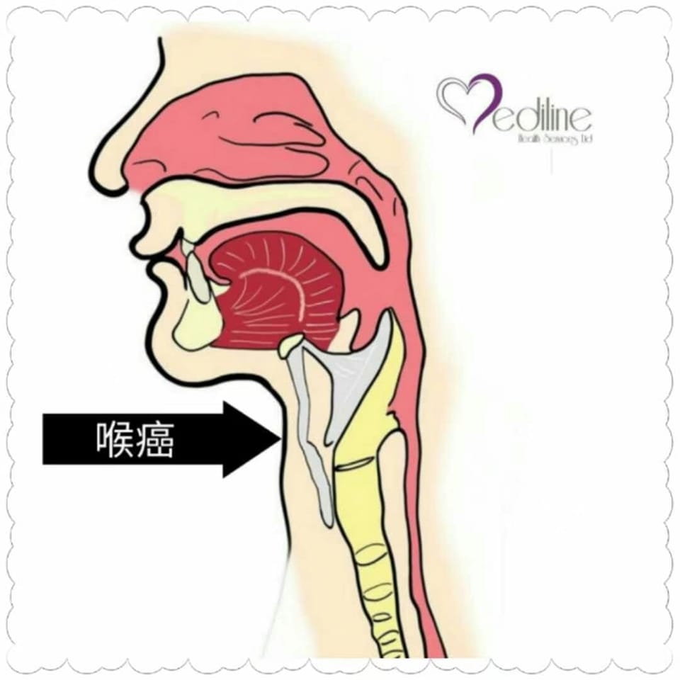 琸盈體檢顧問有限公司 - 【認識喉癌】 甚麼是喉癌？...