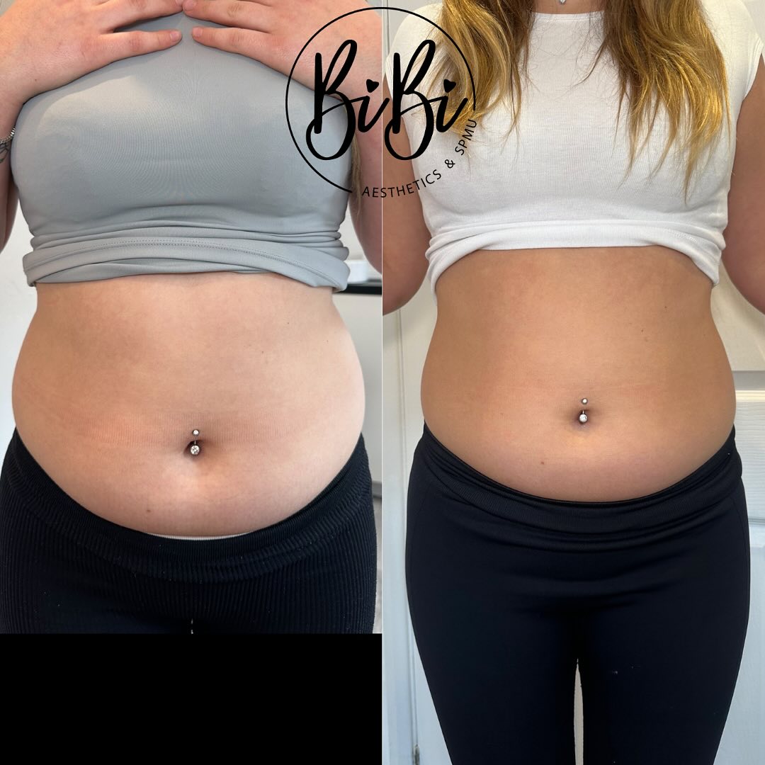 lemon bottle fat dissolving las vegas Lemon Bottle: Fat Dissolving Treatment