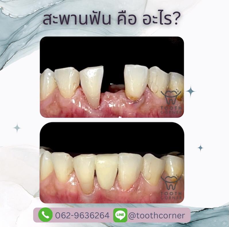 🤨 สะพานฟัน... - Tooth Corner Clinic - ทูธคอร์เนอะ สหคลินิก | Facebook
