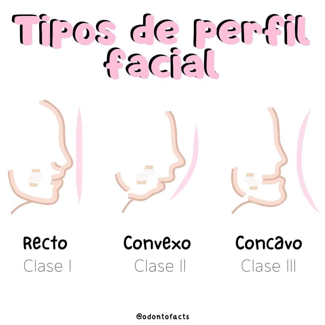 Dental - Tipos de perfil. 👤Perfil facial recto: Se forma una línea casi ...