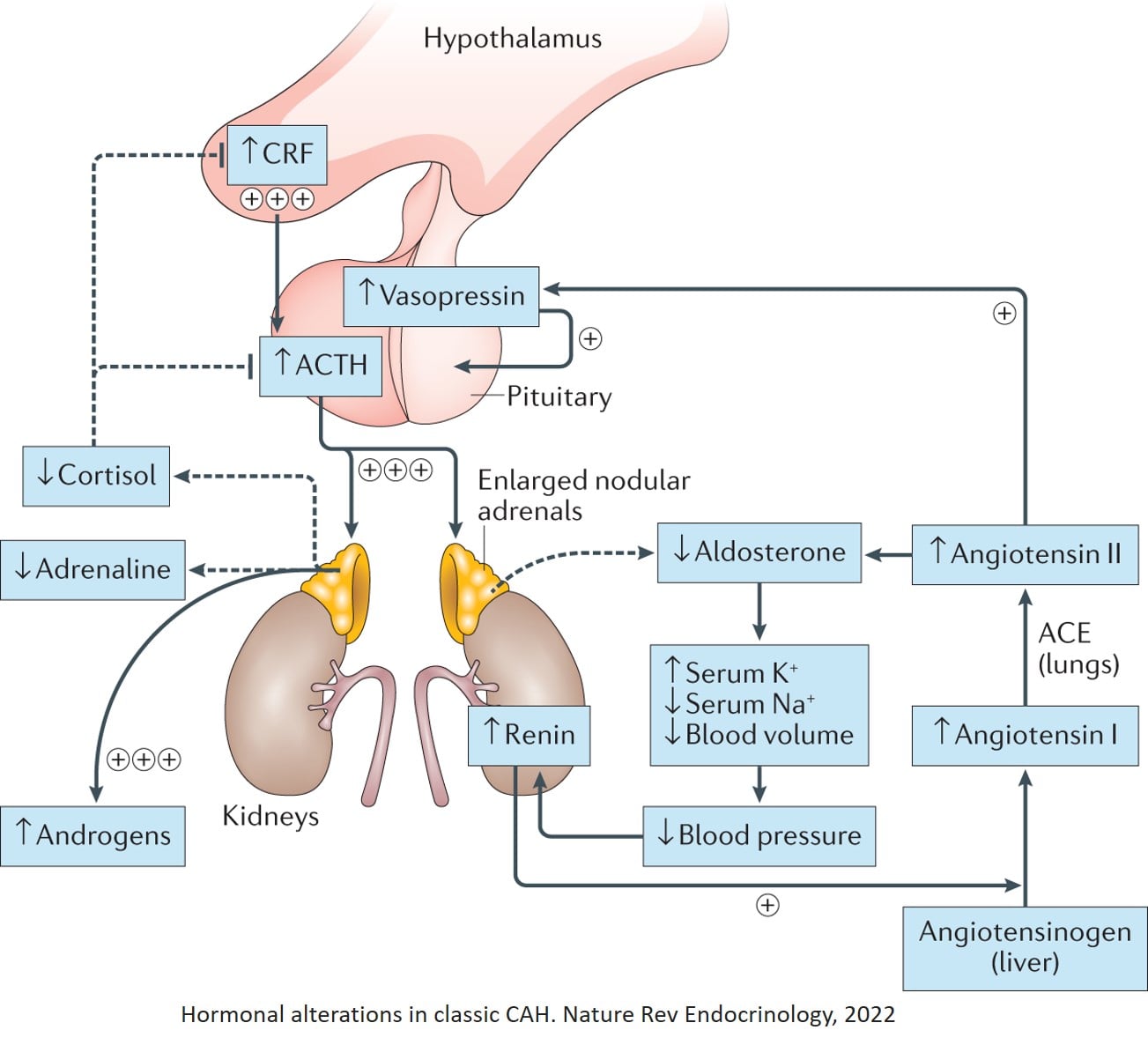 Science News Highlights - Congenital adrenal hyperplasia (CAH) In ...