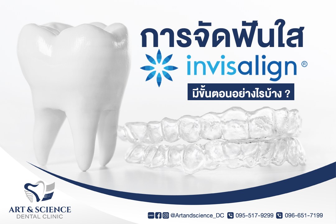 ขั้นตอนในการจัดฟันใส (Invisalign) มีอะไรบ้างนะ ? . เมื่อมาจัดฟันใสที่ ...