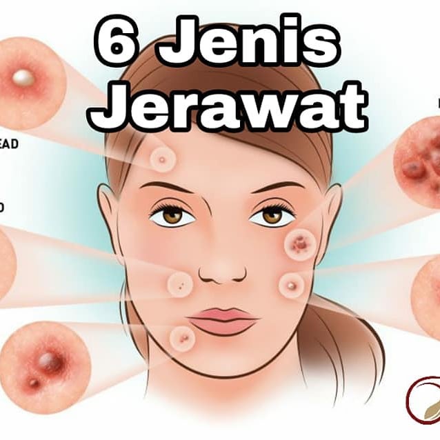 Siti Za Ba 6 Jenis Jerawat Yang Ada Di Wajah Facebook