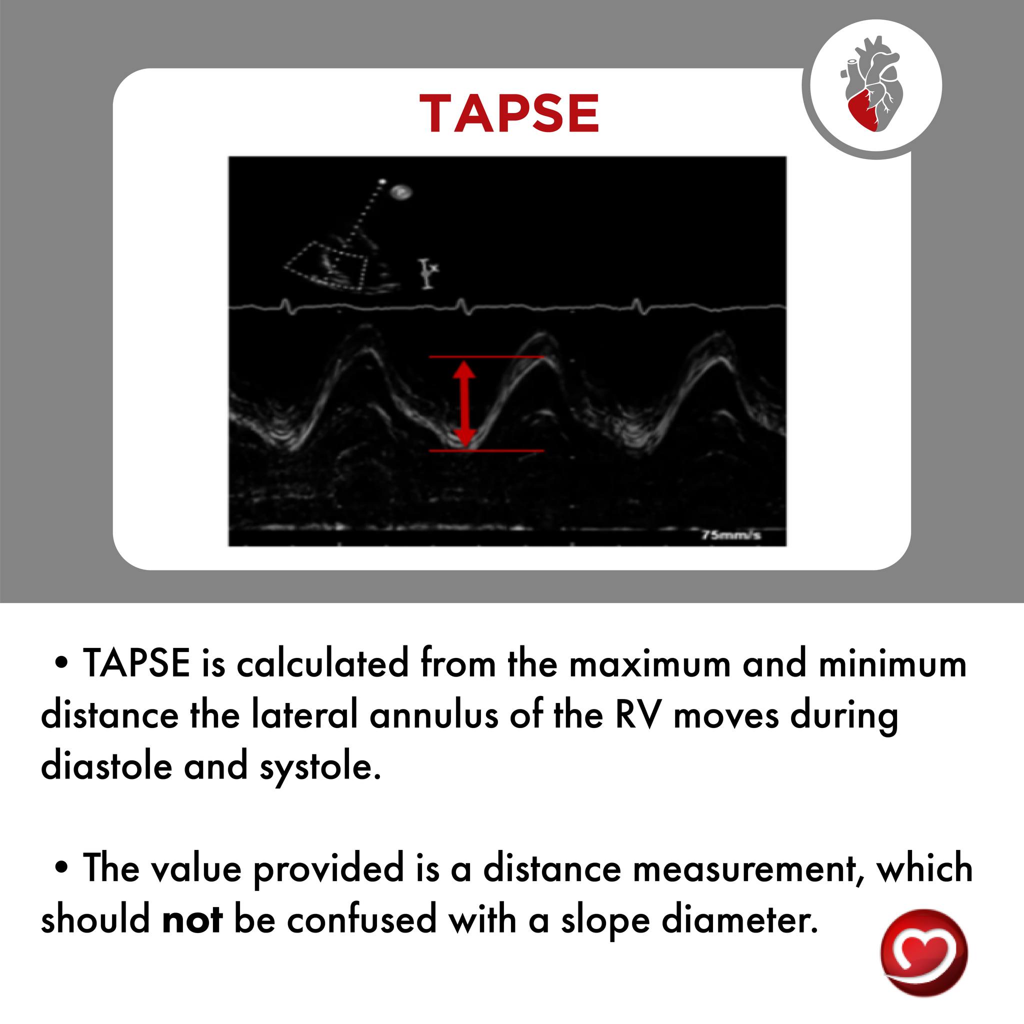 CardioServ, LLC - Right Heart | How is TAPSE calculated?... | Facebook