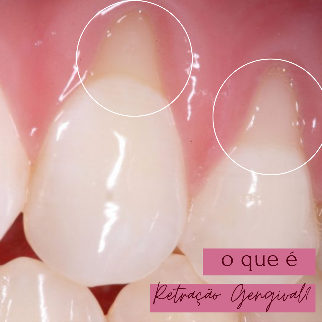 📍 RETRAÇÃO OU... - Natiélli Engroff - Cirurgiã Dentista | Facebook