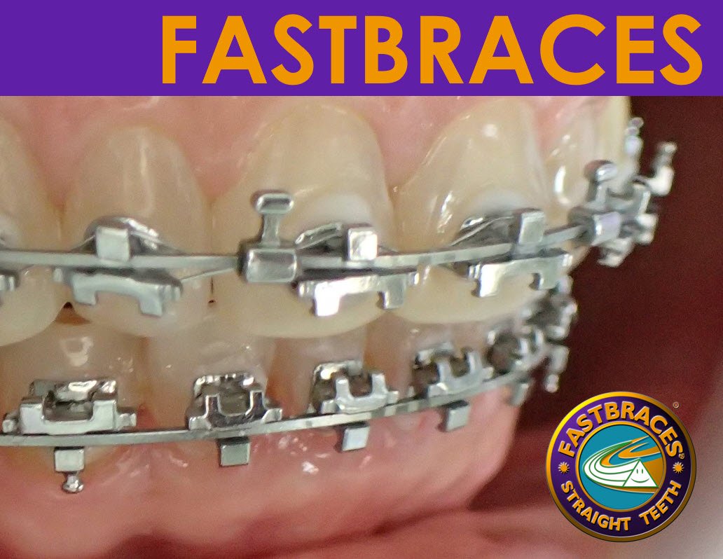 เรื่องน่ารู้เกี่ยวกับ FASTBRACES... - คลินิกทันตกรรมสีขาว