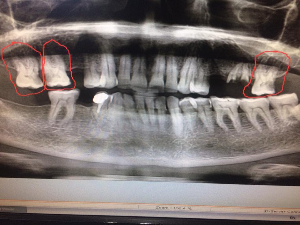 RCT cases for... - DR. Mohammed Al-Khateeb د. محمد الخطيب | Facebook