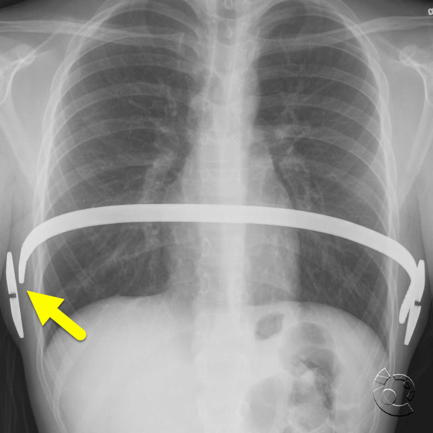 Frontal (image 1) and lateral... - Radiology Warriors