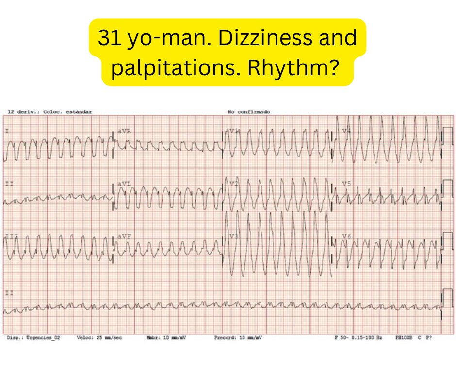 EKG - ⚫️ Identify the following rhythm ? ⚫️ 31 yo-man. Dizziness and ...