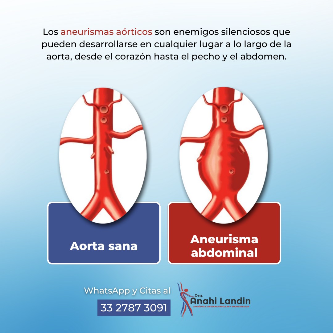 ANEURISMAS AÓRTICOS 🤒 🙌🏼Los aneurismas... - Dra Anahi Landin