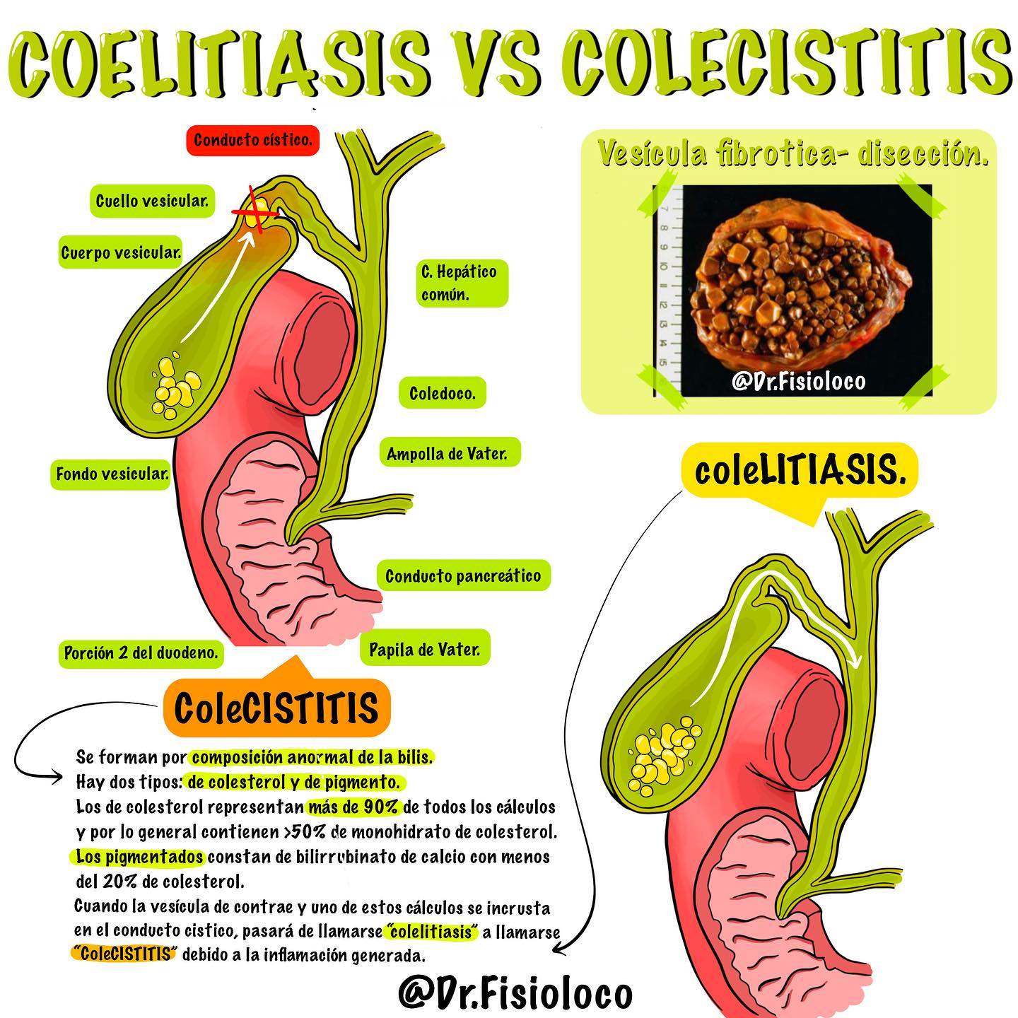Dr.fisioloco - COLELITIASIS vs COLECISTITIS. Algo importante a recalcar ...