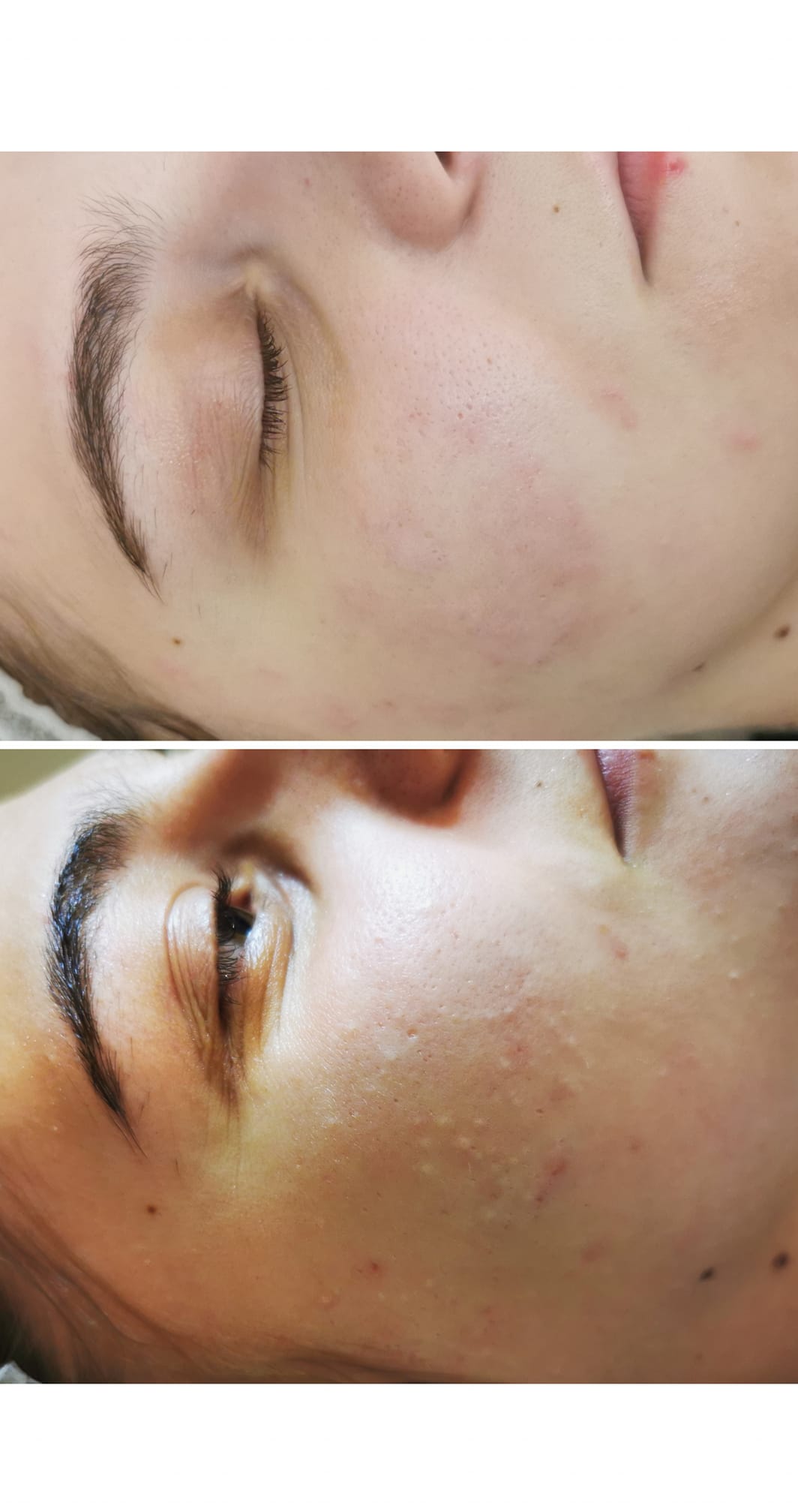 Cosmetica - Punctele de grasime,cunoscute in termeni medicali sub ...