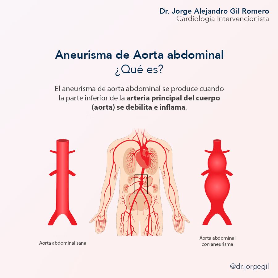 Aneurisma De Aorta: Qué Es, Síntomas Y Tratamiento – CAJI