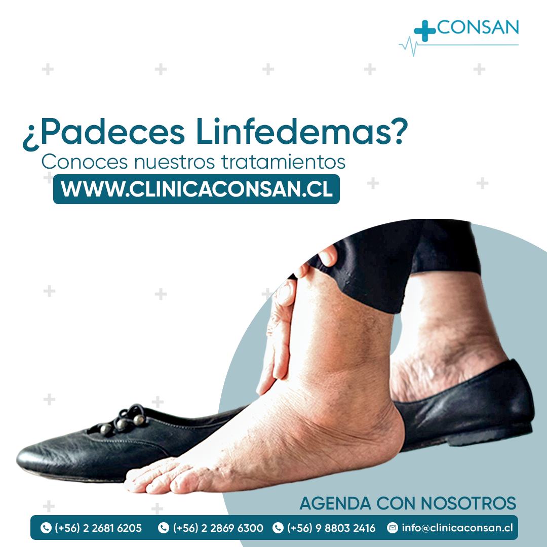 Consan - El linfedema es la acumulación anormal de líquido...