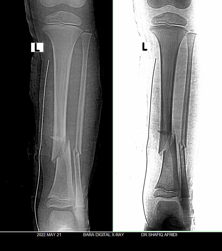 Tibia and Fibula... - باڑہ ڈیجیٹل ایکسرے Bara Digital X-ray