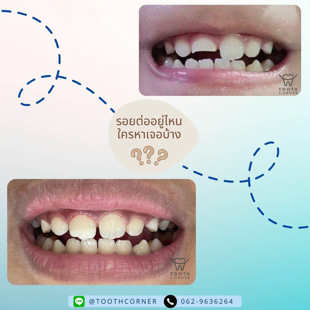 ทำอย่างไรเมื่อ... - Tooth Corner Clinic - ทูธคอร์เนอะ สหคลินิก