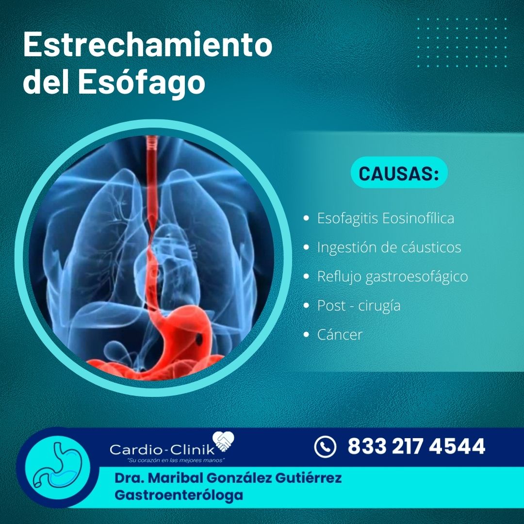 Dra. - 🔵¿Qué es una estenosis esofágica? 🔵 La estenosis es un ...
