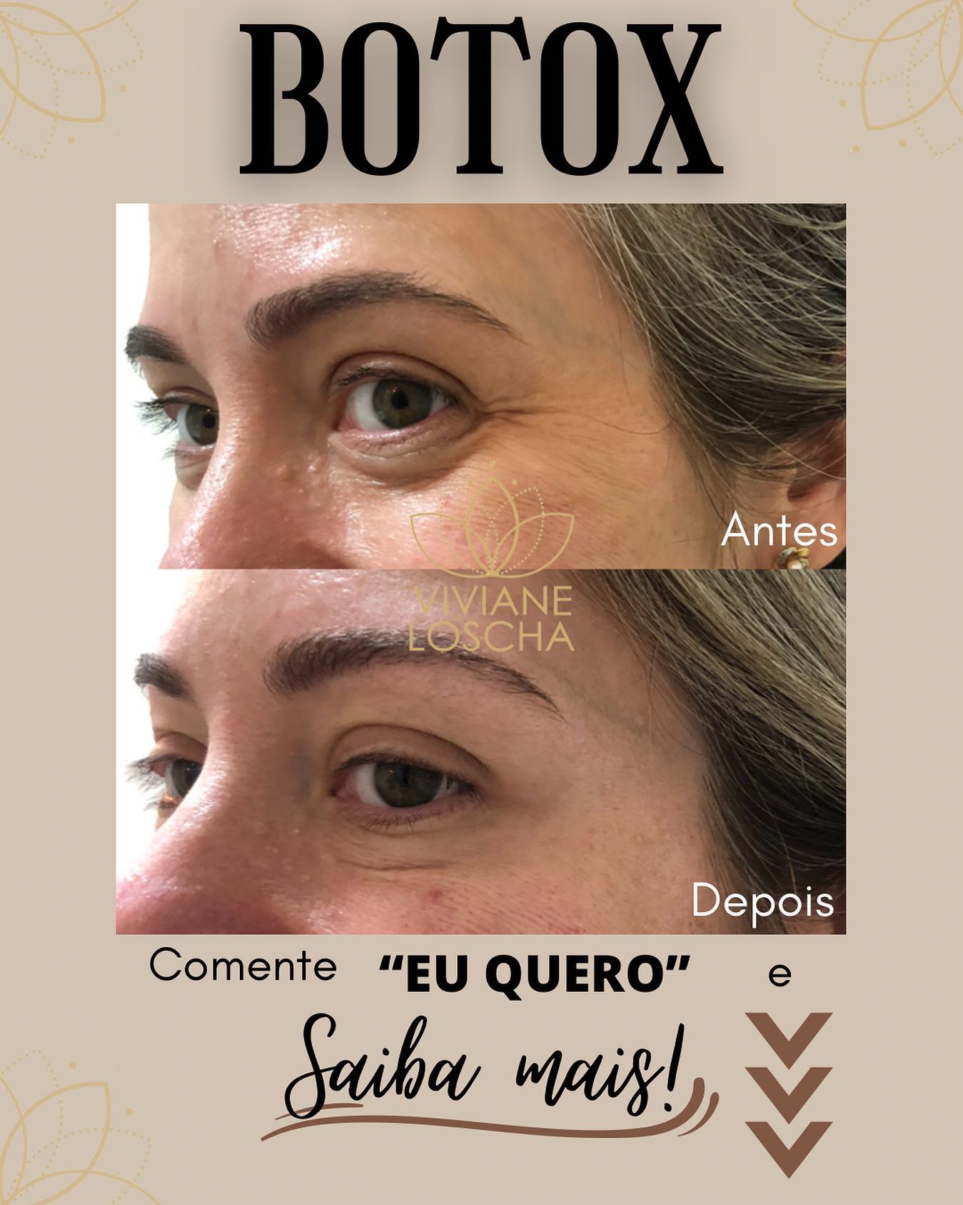 💉 BOTOX é o queridinho das... - Clínica Viviane Loscha