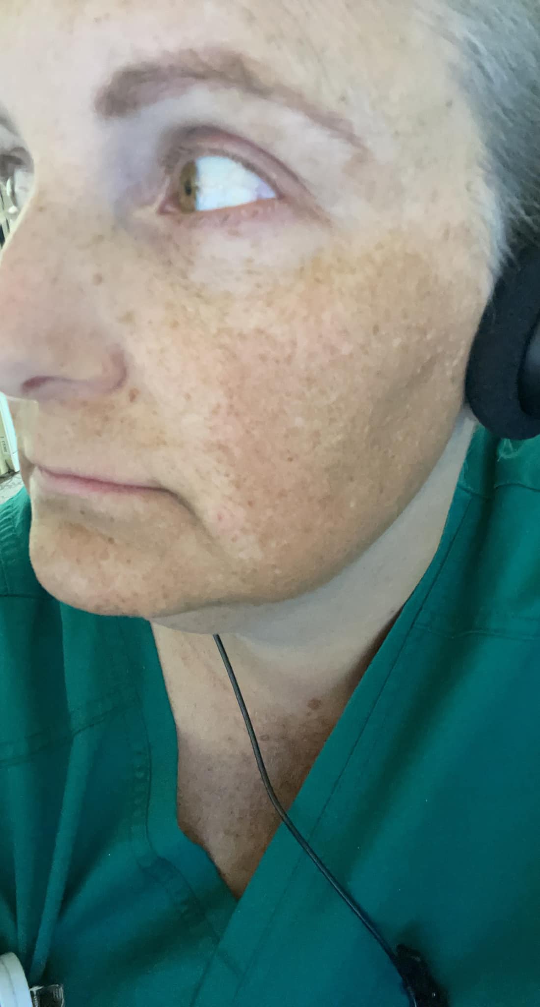 glutathione plaquenil hyperpigmentation People with congenital adrenal hyperplasia can have patches of discolored skin called hyperpigmentation. Here's why and what to do We’d love to help! مشروب لبشرة مشرقة Size:20MG