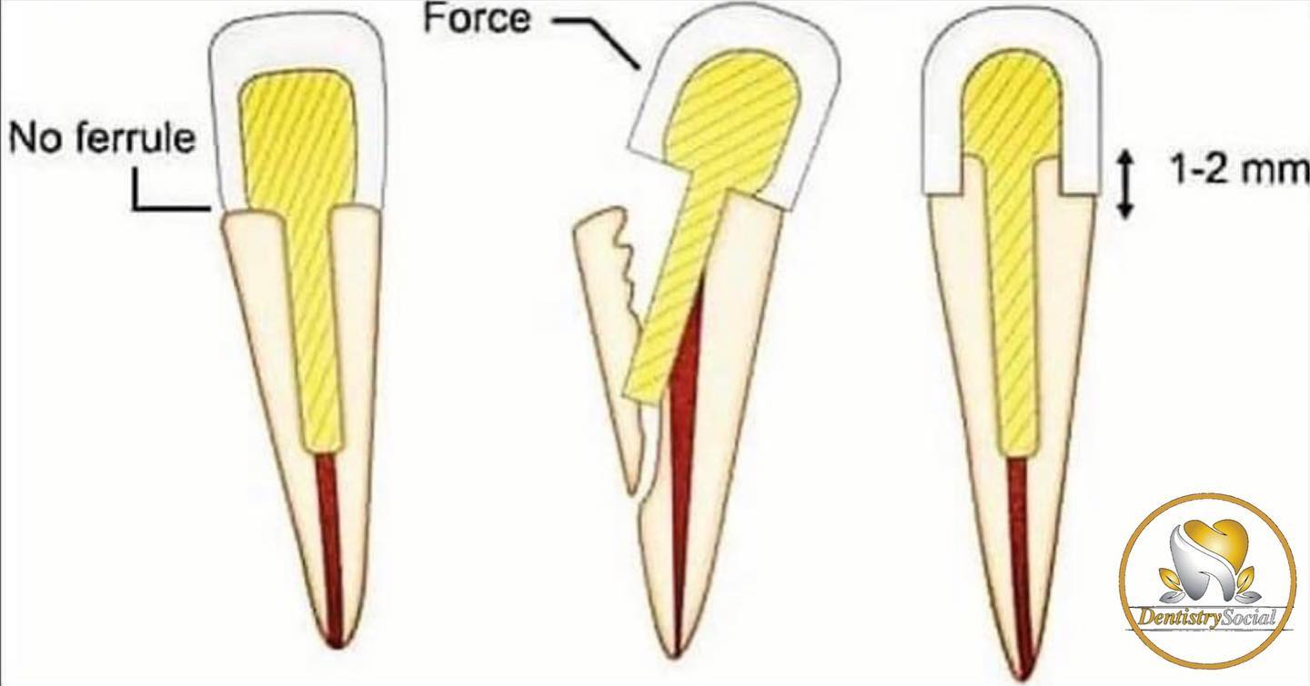 dentistrysocial - Ferrule Follow 👉🏻 @mobindaneshvar...