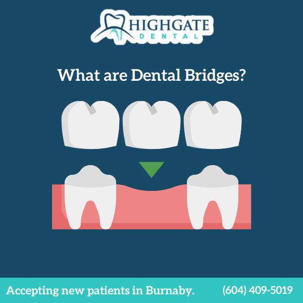HighGate Dental - What are dental bridges? Dental bridges...