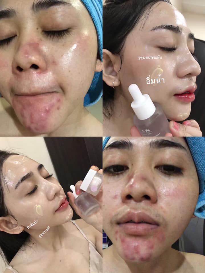 แวะมาอวดรีวิว 🪄 อยากหน้าใส ไร้สิว... - ครีมms mild skin | Facebook