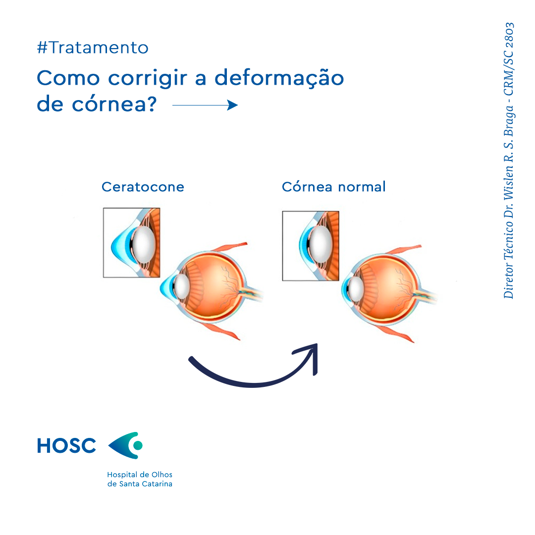 A deformação... - HOSC - Hospital de Olhos de Santa Catarina