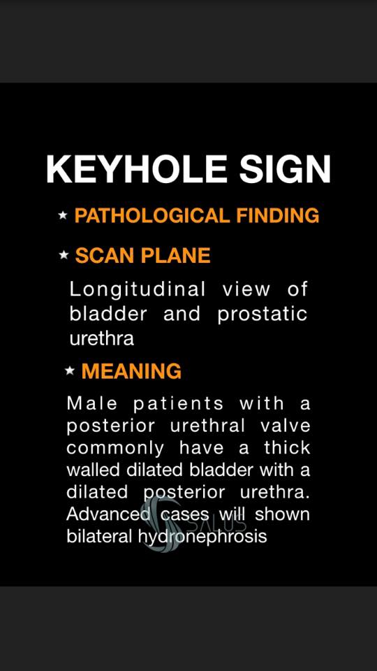 💥The KEYHOLE SIGN is an... - Salus sonography | Facebook