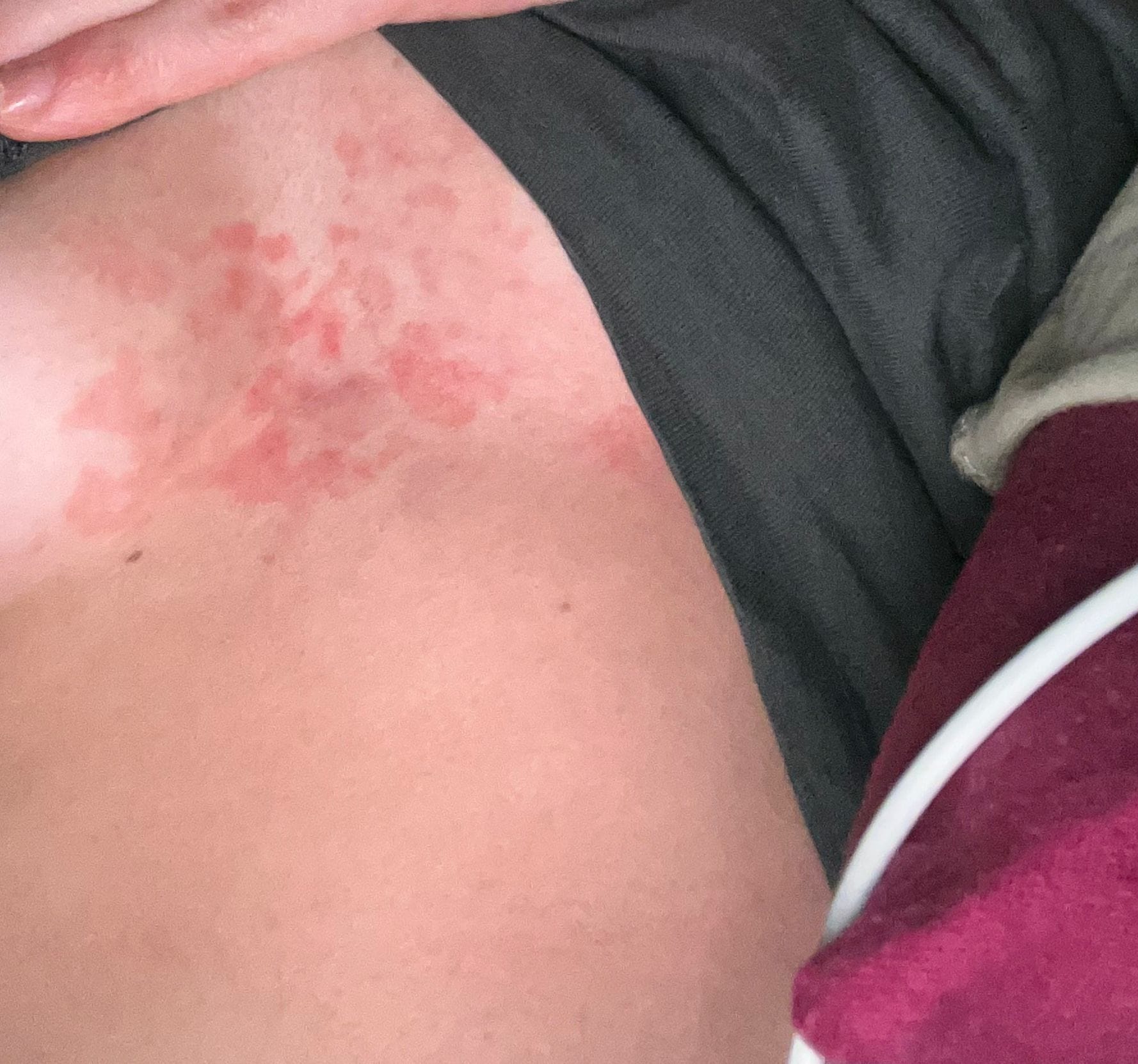 can l carnitine cause rash Carnitine: the claims and why it may not work Has anyone experienced keto rash