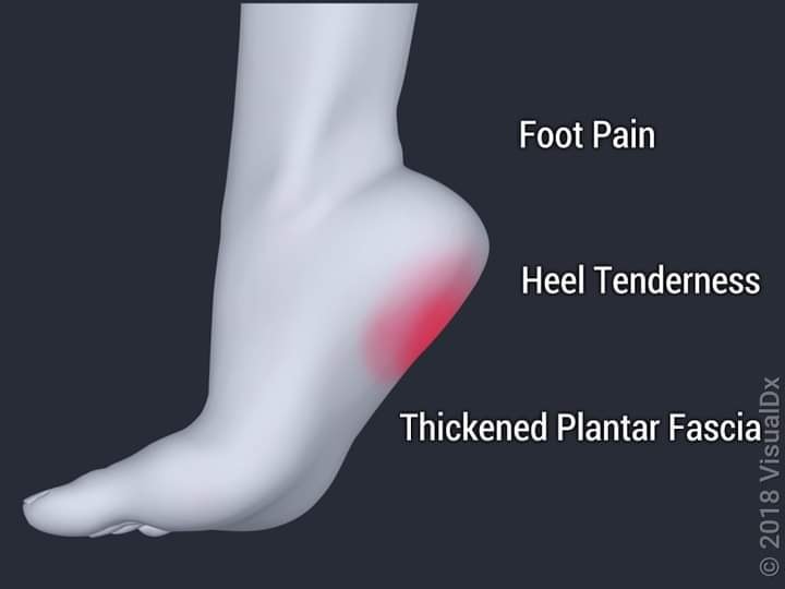 Where to inject bpc157 for plantar fasciitis?