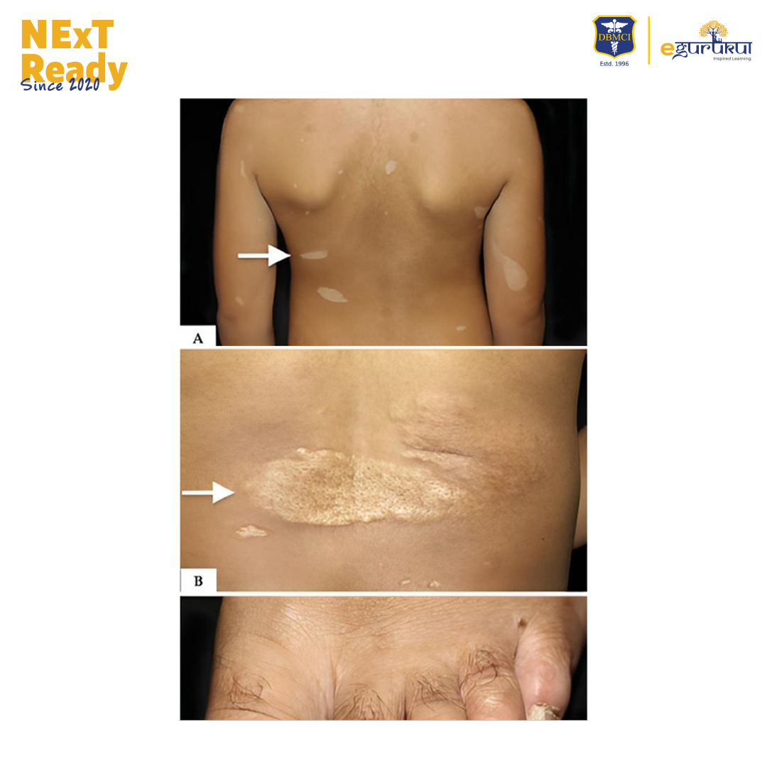 Tuberous Sclerosis Shagreen Patch
