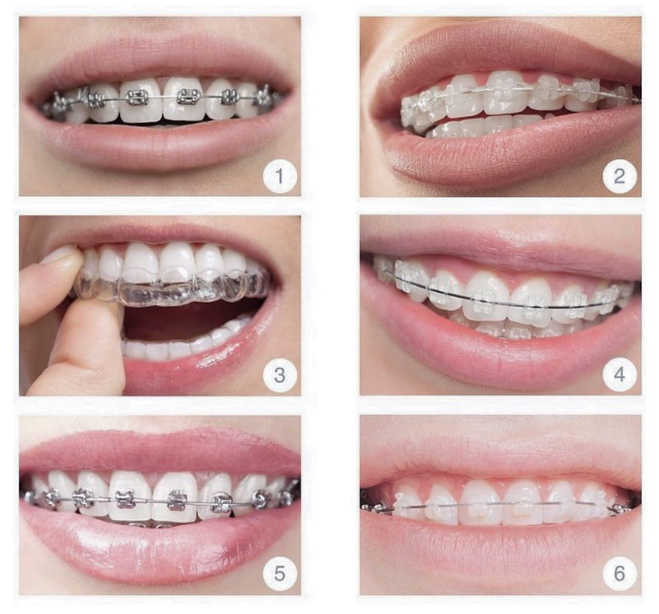 Alana - Quieres alinear tus dientes pero no quieres brackets?? Existen ...