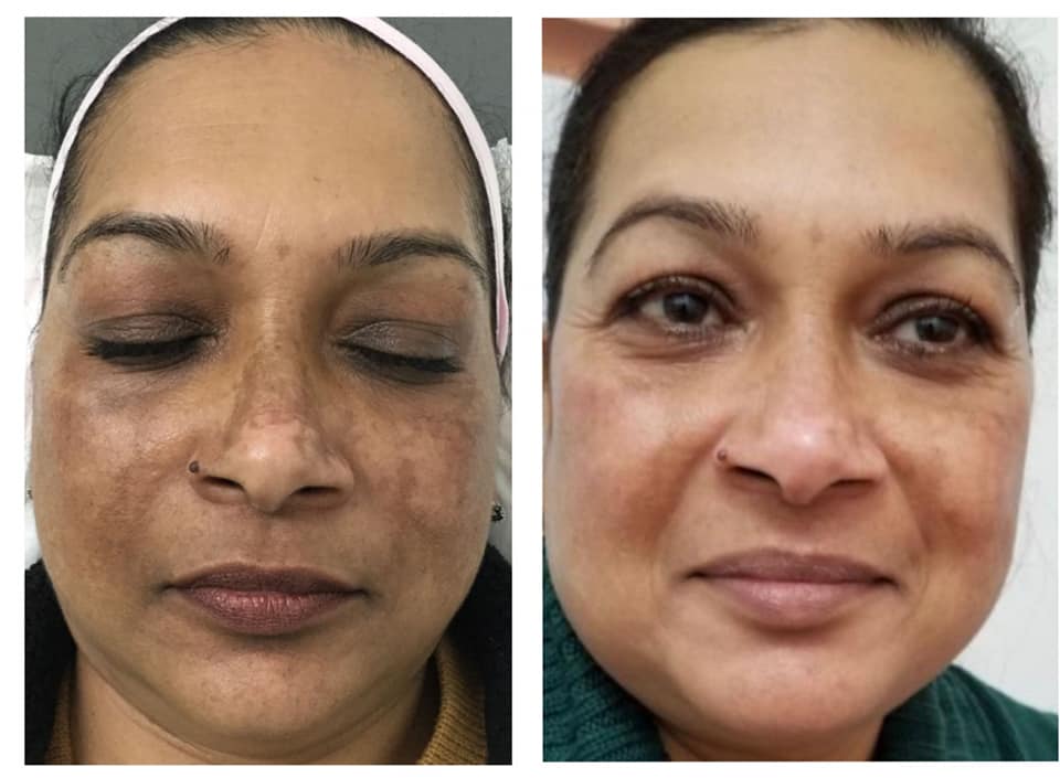 Models for the Glutathione signature skin booster treatment. This treatment is tailored towards skin quality and focuses on pore size, hyperpigmentation, dryness and general skin quality. This offer ends on the 9th