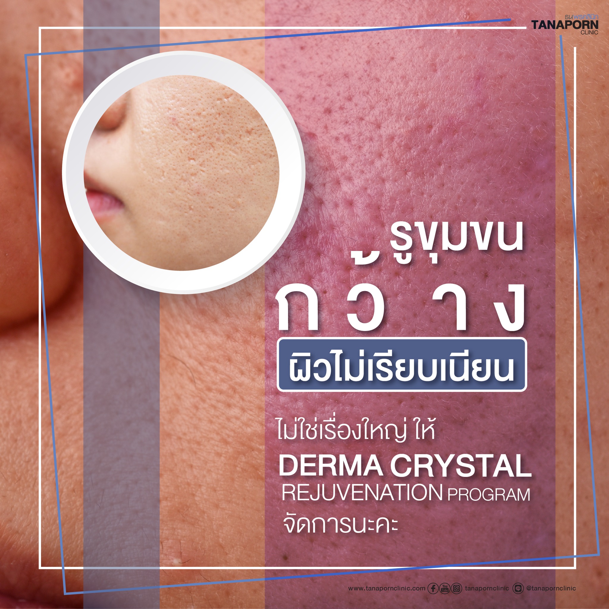 ธนพรคลินิก - DERMA CRYSTAL REJUVENATION PROGRAM คือ... | Facebook