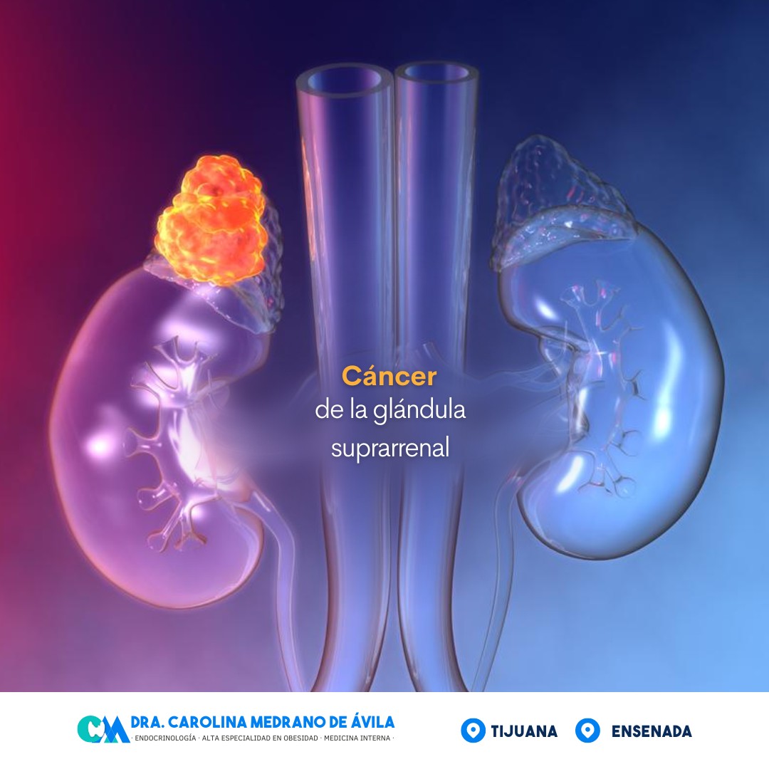 Un tumor... - Endocrino Carolina Medrano De Ávila