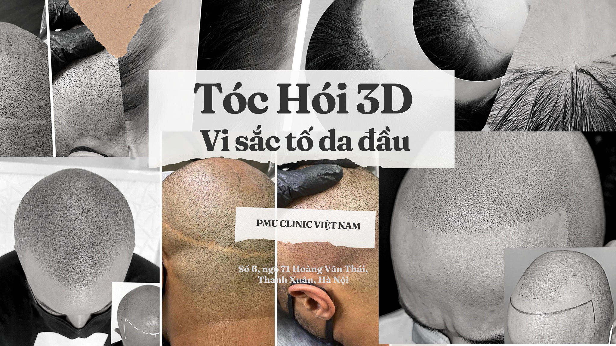 Tóc hói 3D - Vi sắc tố da đầu | Hanoi