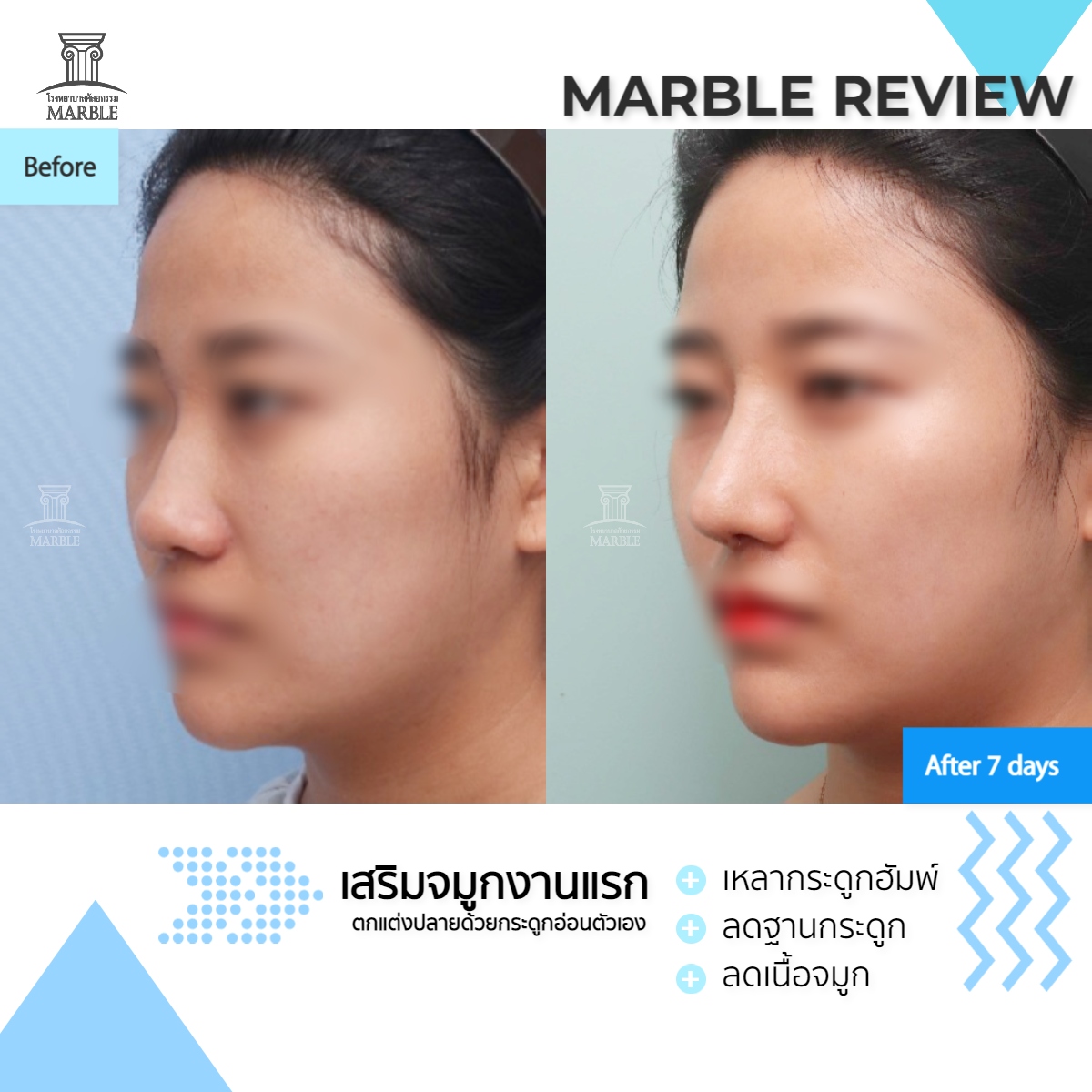 #Marbl... - โรงพยาบาลศัลยกรรม มาร์เบิ้ล Marble Plastic Surgery | Facebook
