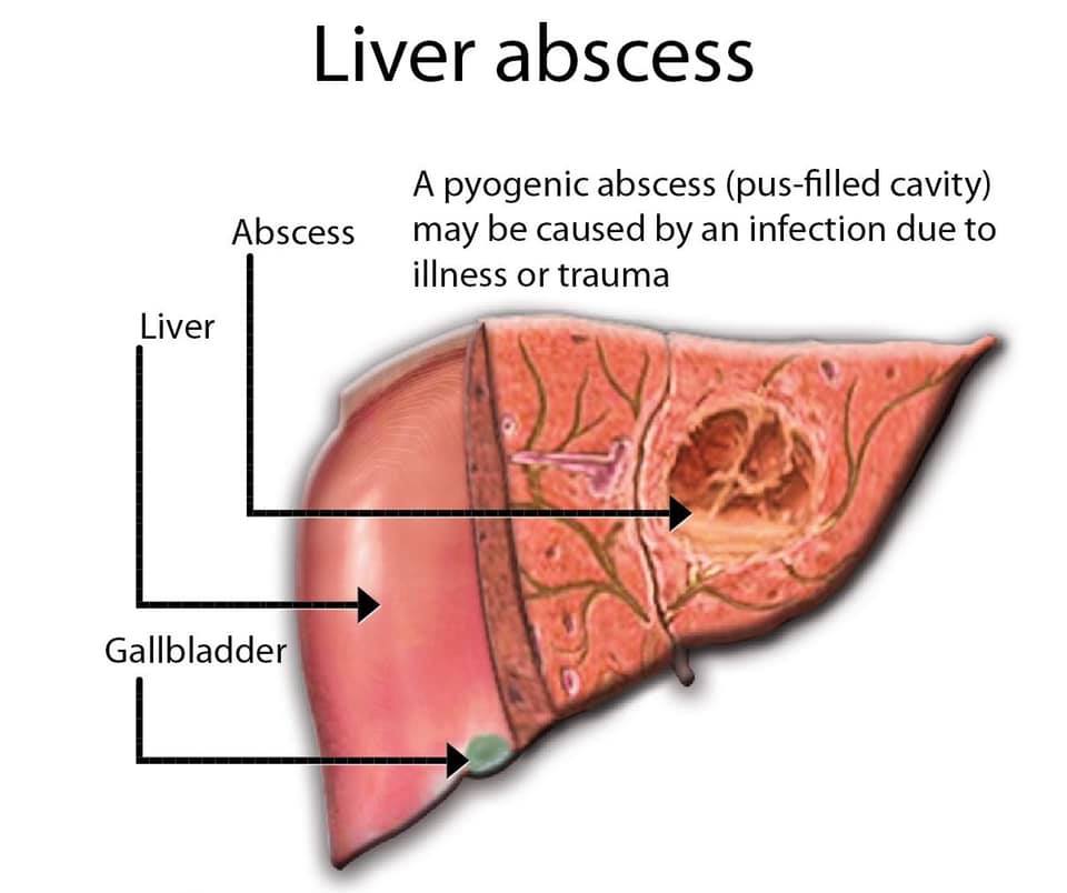 Liver abscess is a pus-filled cyst in... - Diagnos Clinique