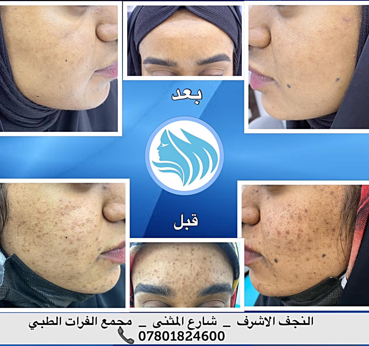 🔹علاج تصبغات مابعد الالتهاب (نتيجة حب شباب شديد) باستخدام علاجات موضعية ...